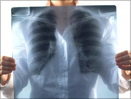 Россия может выйти из списка стран ВОЗ с высоким уровнем туберкулеза