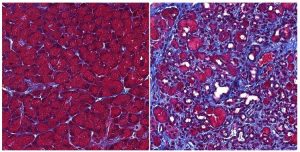Слева: ацинарные клетки (красные) в здоровой поджелудочной железе. Справа: обширное рубцевание поджелудочной железы (фиолетовое)