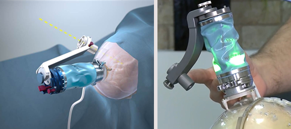 Mazor Robotics улучшает прогноз благодаря развитию хирургических роботов