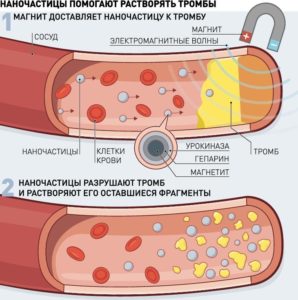 Нано наносит удар — российские ученые придумали, как быстро рассасывать тромбы