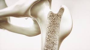 Amgen установила стоимость нового препарата-блокбастера для лечения остеопороза