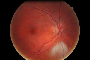 ИИ помог выявлять болезнь Паркинсона на ранних стадиях по снимкам глазного дна