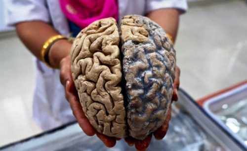 COVID-19 способен навредить мозгу сильнее болезни Альцгеймера