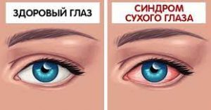 Здоровый глаз и синдром ухого глаза