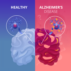 Белковые бляшки - причина болезни Альцгеймера