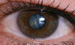 Лечение катаракты