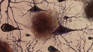 Обнаружено удивительное сходство между болезнью Альцгеймера и длительным COVID-19