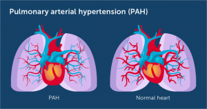 Легочная артериальная гипертензия
