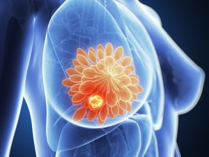 Открытие ученых может стать прорывом в лечении рака груди