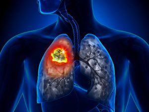 Анализ близлежащих здоровых тканей может помочь предотвратить рецидив рака легких