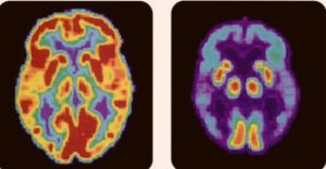 Ученые впервые выявили возможность заражения болезнью Альцгеймера