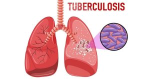 Туберкулез снова стал самым смертоносным инфекционным заболеванием на планете